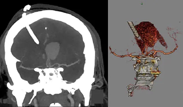 Intracerebral hemorrhage and external ventricular drain