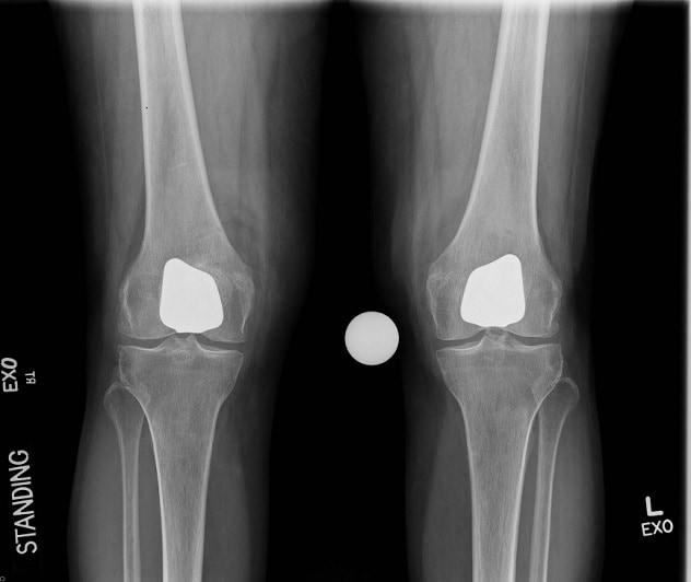 Partial knee replacement benefits eligible patients Mayo Clinic