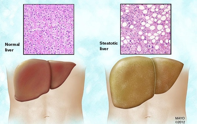 Depósitos de grasa en un hígado esteatósico