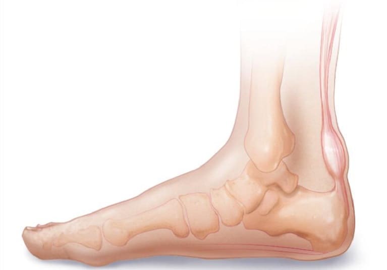 Achilles Tendinopathy - Hersco Edu Center