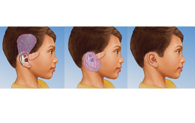 Pediatric surgical reconstruction