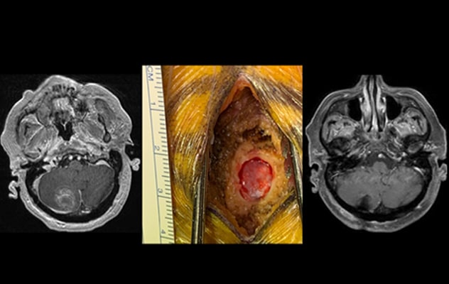 Minimally invasive tumor resection