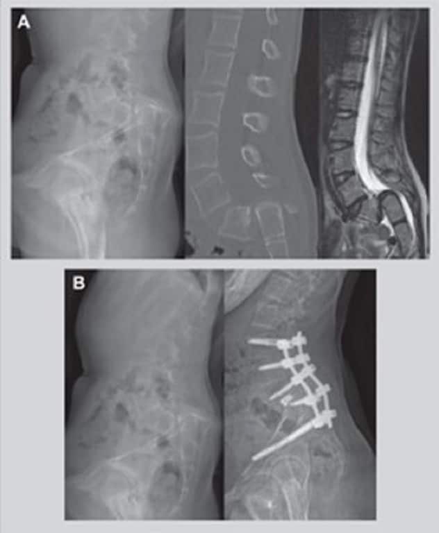 Spondylolisthesis