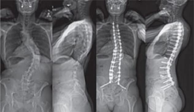 Spinal fusion for scoliosis