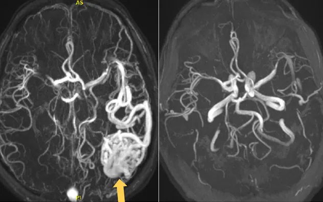 Staged radiosurgery