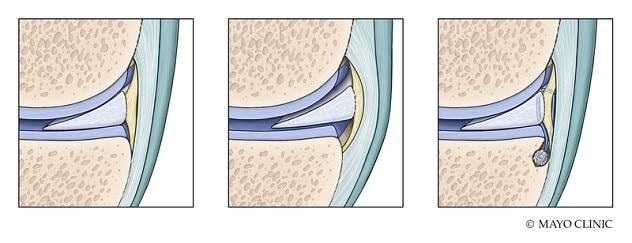 Meniscus centralization