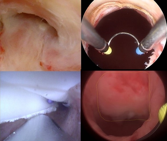 Injerto endoscópico de mucosa bucal