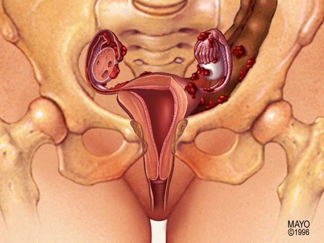 Endometriosis