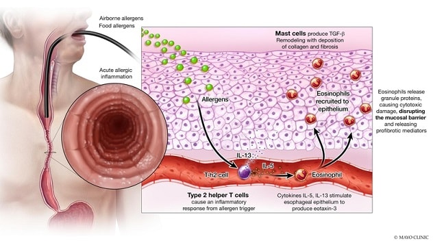 Eosinophilic esophagitis