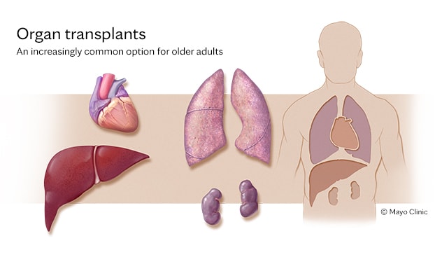 Solid organ transplants