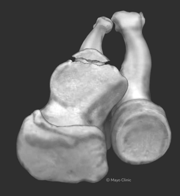 Fracture patterns of the coronoid