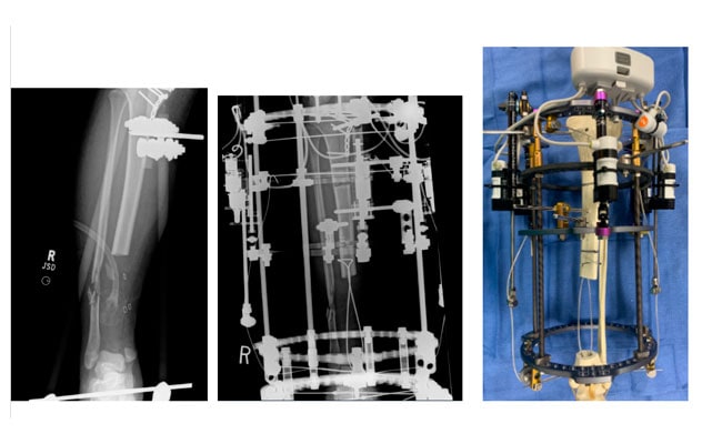 Automated external circular frame and intramedullary cables