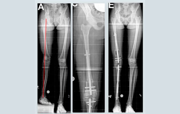 Deformity correction, lengthening