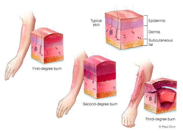 Campfires: Preventing and treating pediatric burn injuries in your ...