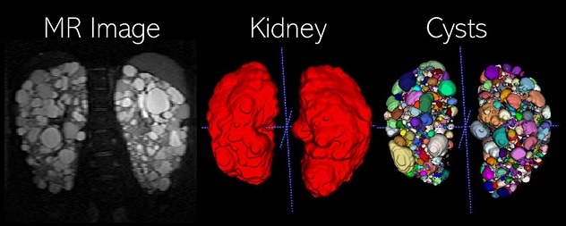 Abdominal MR Imaging in PKD