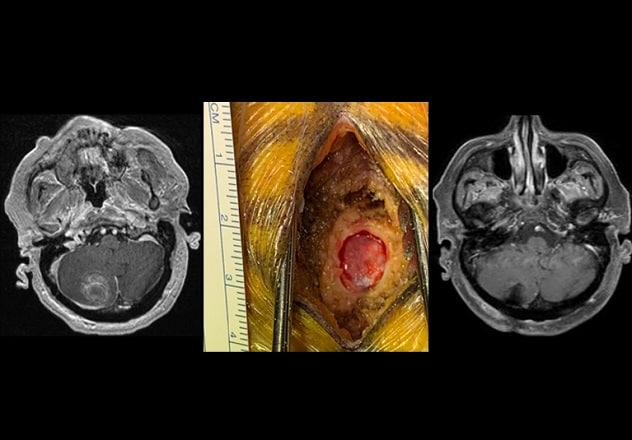 Minimally invasive tumor resection