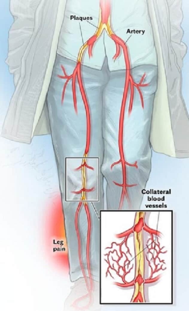 Leg pain from PAD