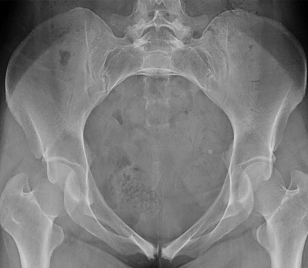 Preoperative inlet view