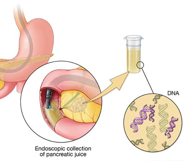 Liquid biopsy approach for detecting pancreatic ductal adenocarcinoma (PDAC)