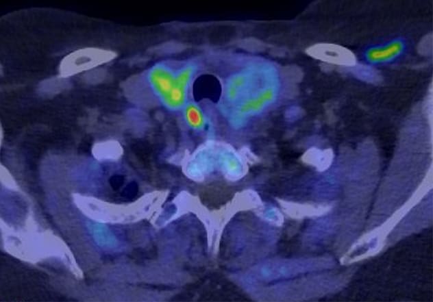 C-11 choline PET/CT