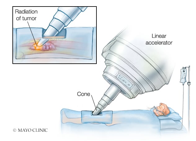 Intraoperative radiation therapy
