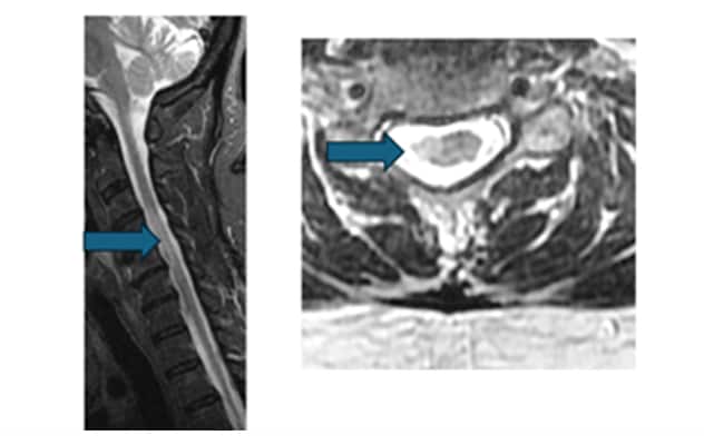 Critical demyelinating spinal cord lesion