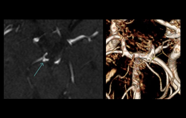Distinguishing aneurysm from infundibula