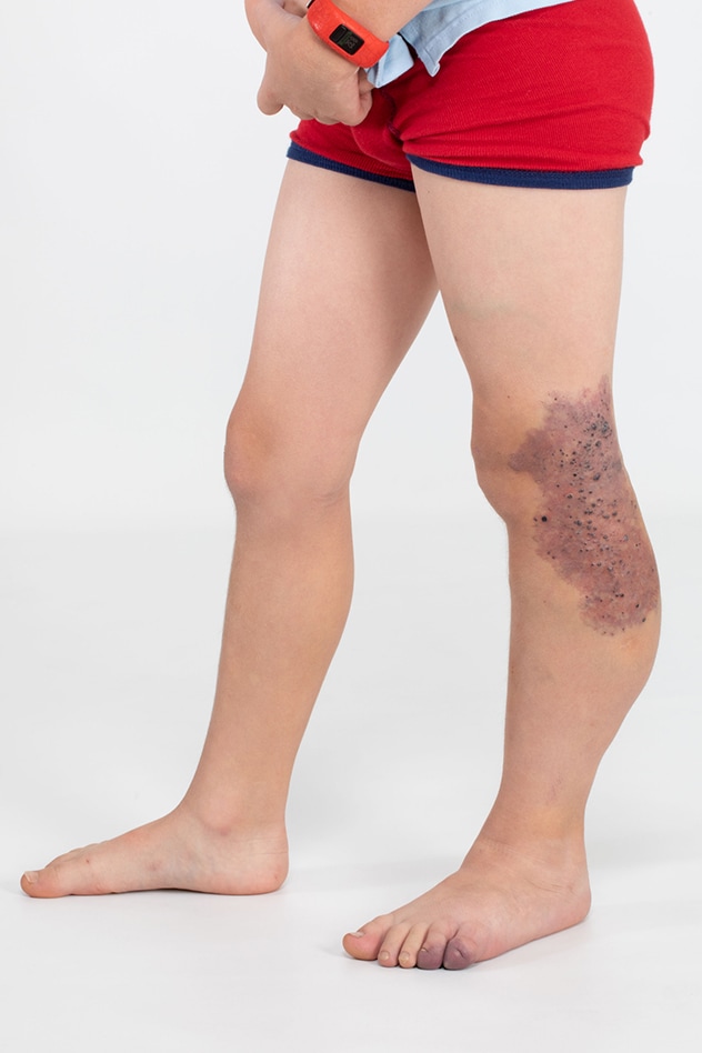 Congenital lipomatous overgrowth syndrome
