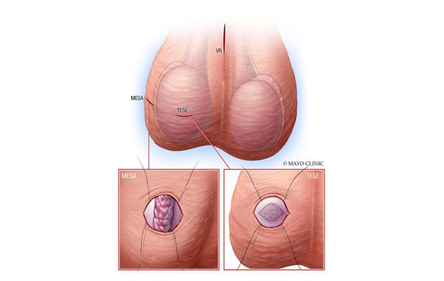 Vasectomy reversal 