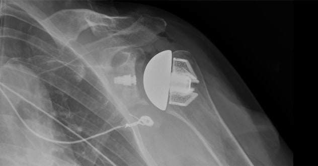 Postoperative X-ray