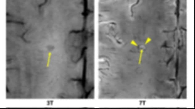 Technology that captures MS biomarkers