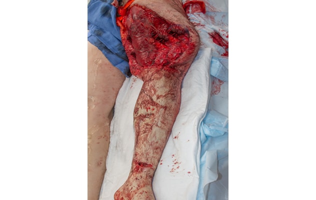 Farm-related extremity injury