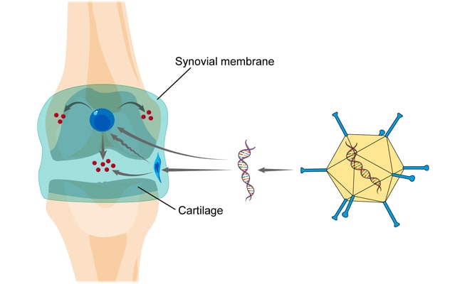 Intra-articular gene therapy