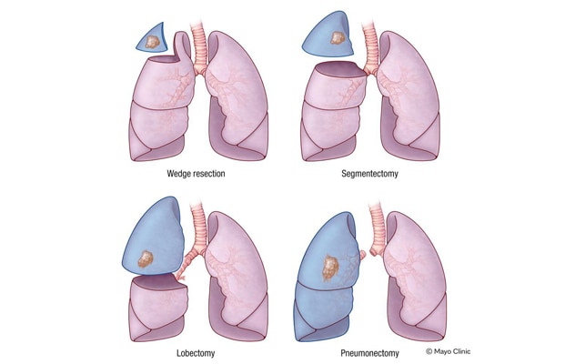 Lung cancer surgeries