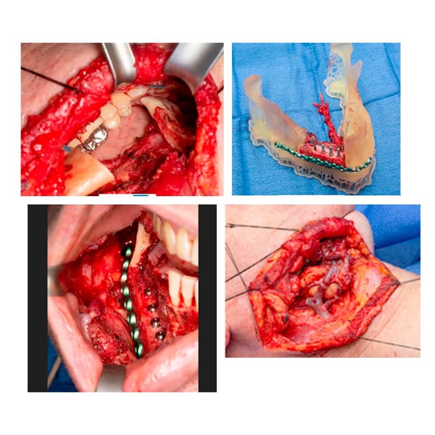 Free-flap reconstruction