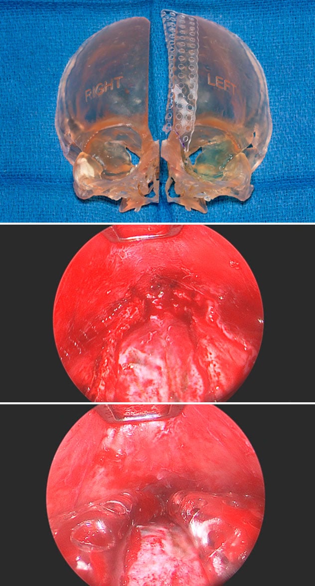 Avoiding helmet therapy