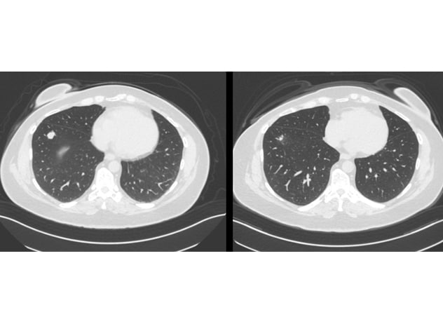 Lung lesion