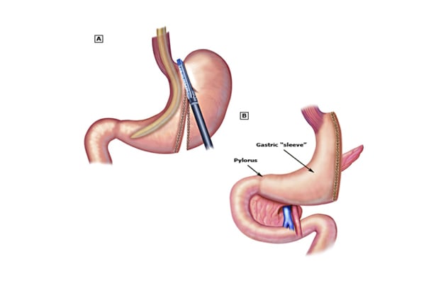 Sleeve gastrectomy