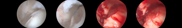 Treatment of a medial talar dome osteochondral lesion