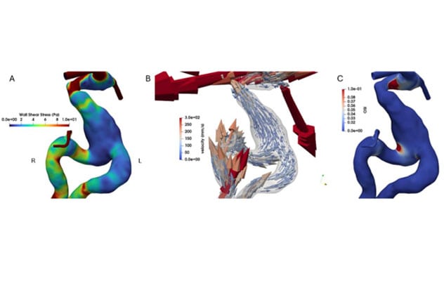 Guiding aneurysm care