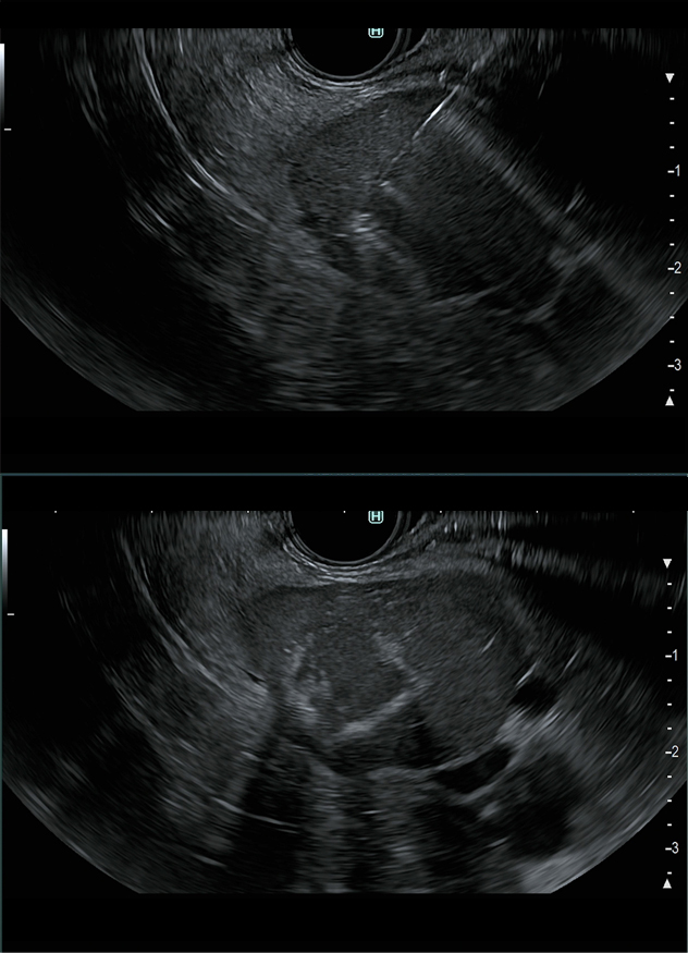 Radiofrequency ablation
