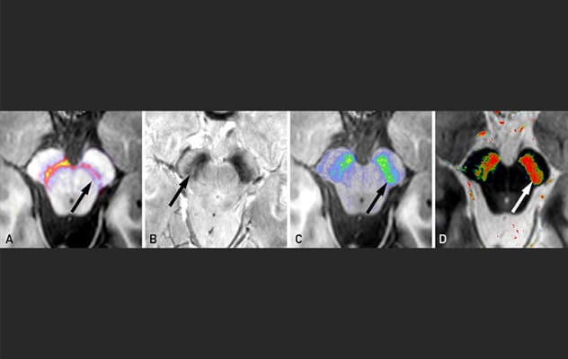 Visualizing Parkinson's disease signs in vivo