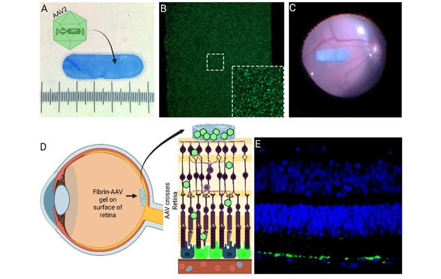 Overview of FE-AAV gene therapy