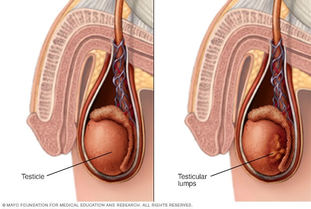 Testicular Lumps Mayo Clinic 