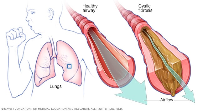 Vía respiratoria normal en comparación con vía respiratoria con fibrosis quística