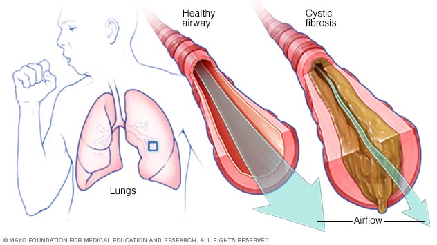 Image result for cystic fibrosis