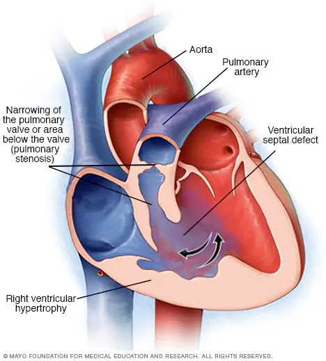 Illustration showing components of tetralogy of Fallot
