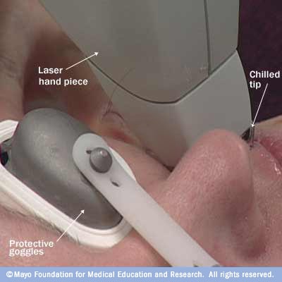 Photo showing laser hair removal 
