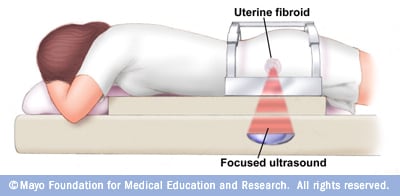Focused ultrasound surgery 
