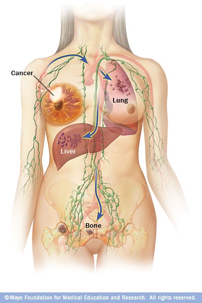 Illustration shows where breast cancer spreads

